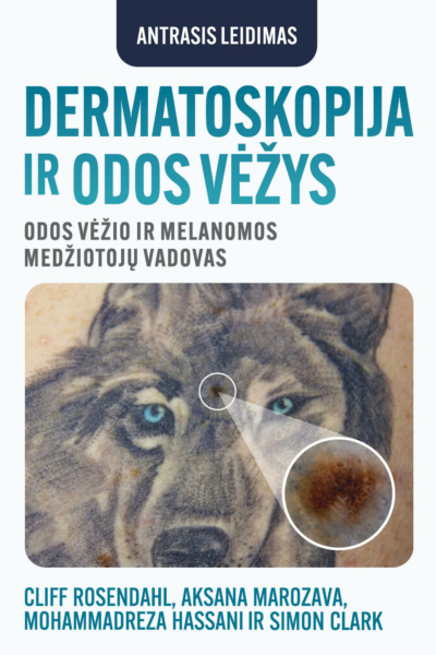 DERMATOSKOPIJA IR ODOS VĖŽYS
